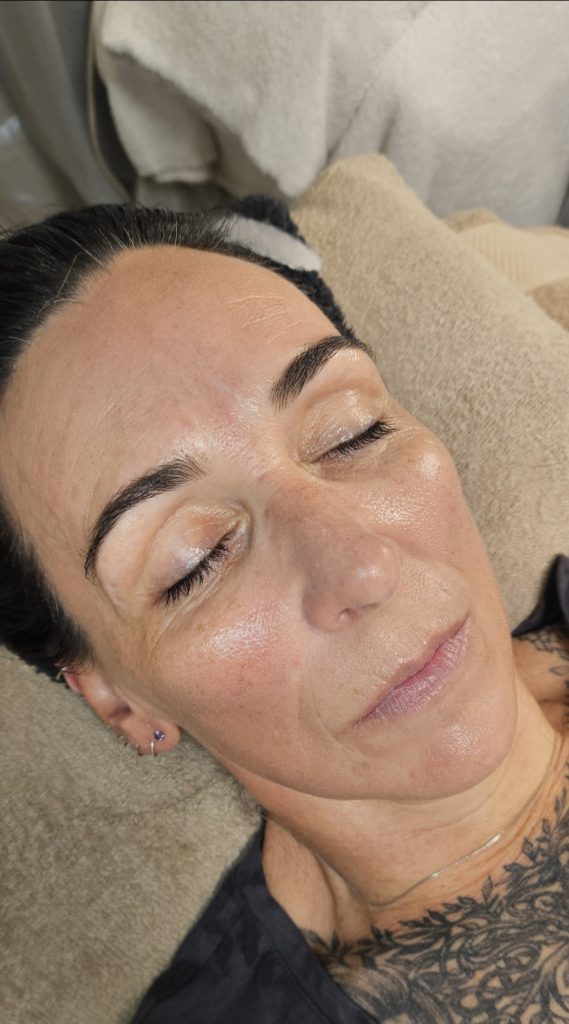 Professional microdermabrasion, skin needling and facial peel treatments at Beauty Habitz Salon, Gold Coast.